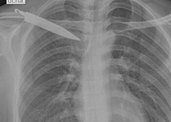 Pangoa: Joven vivió un mes con un cuchillo dentro de su cuerpo