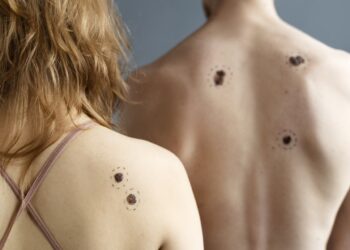 El cáncer de piel tipo Melanoma causa una muerte por día en el país