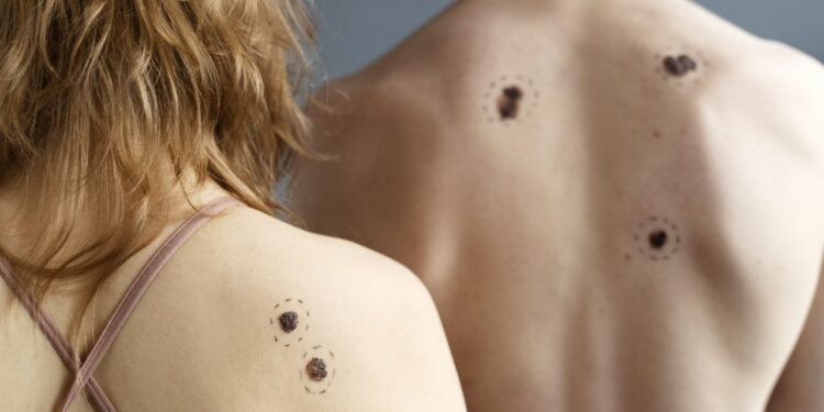 El cáncer de piel tipo Melanoma causa una muerte por día en el país